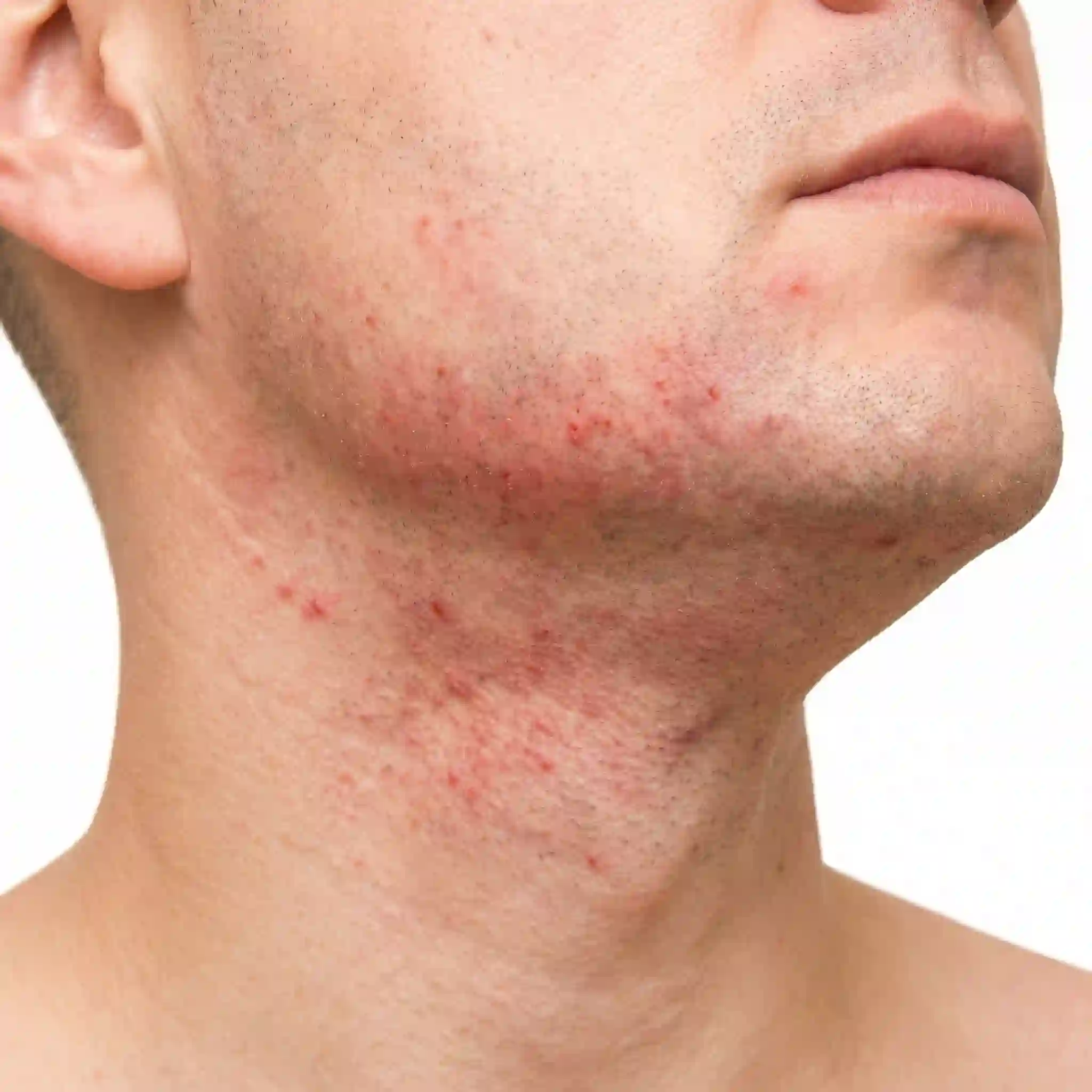 visual guide for razor burn versus razor bumps with best aftershave balm for sensitive skin