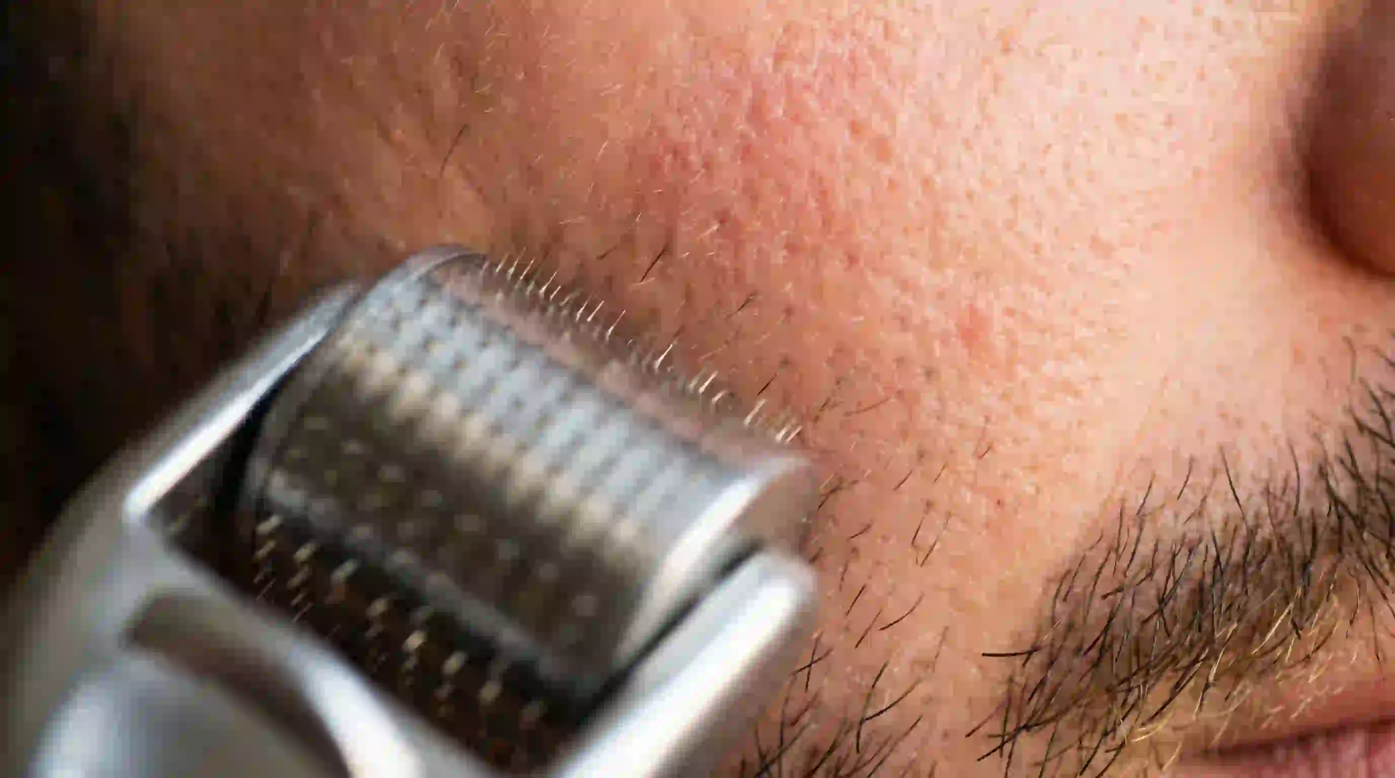 A derma roller device used for microneedling to stimulate blood flow and help dormant follicles grow as part of how to remove patchy beard.