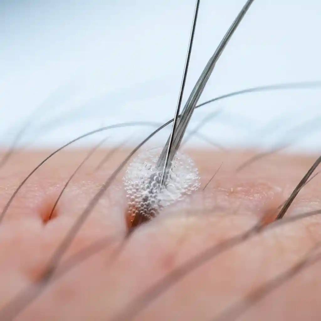 A technician performing electrolysis on a man's face, highlighting it as the only FDA-recognized method for permanent facial hair removal for men with grey or light hair.