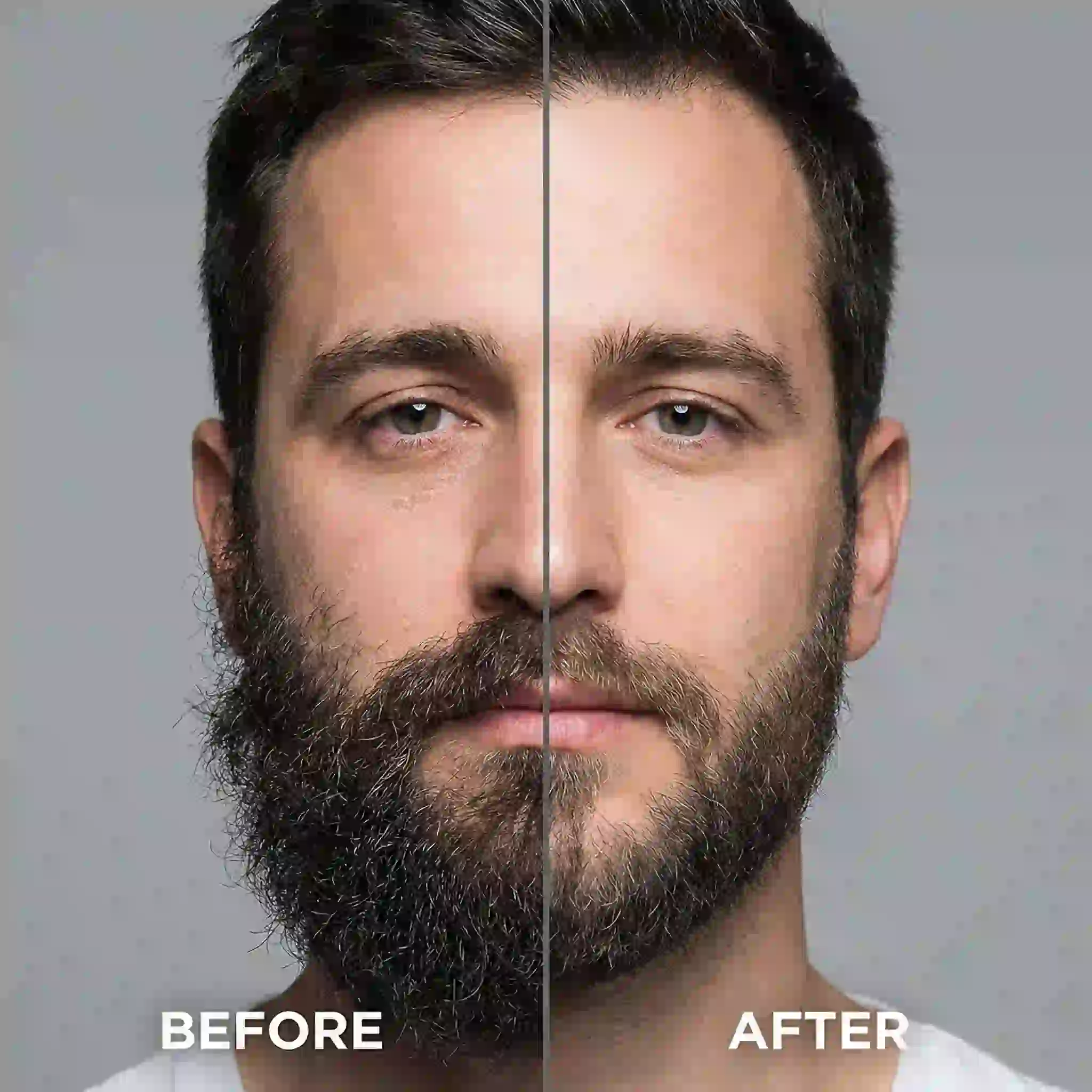 A man with a softer, thinner, and much more manageable beard, highlighting how partial treatments and customized permanent beard removal can significantly reduce excessive hair density.