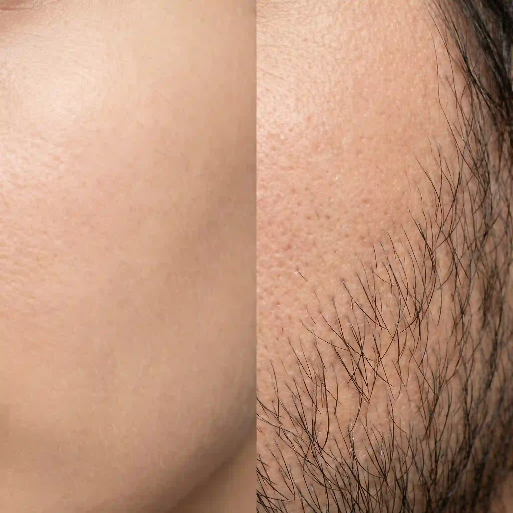 Understanding the difference between vellus and terminal hair is crucial for selecting the right facial hair removal technique to ensure optimal results and prevent unwanted skin irritation during your grooming routine.