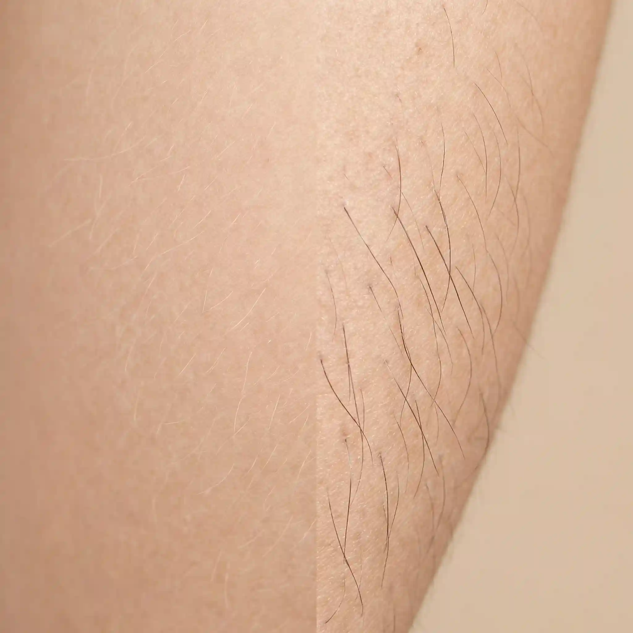 Vellus vs terminal facial hair comparison showing fine peach fuzz against coarser darker hormonally influenced hair types